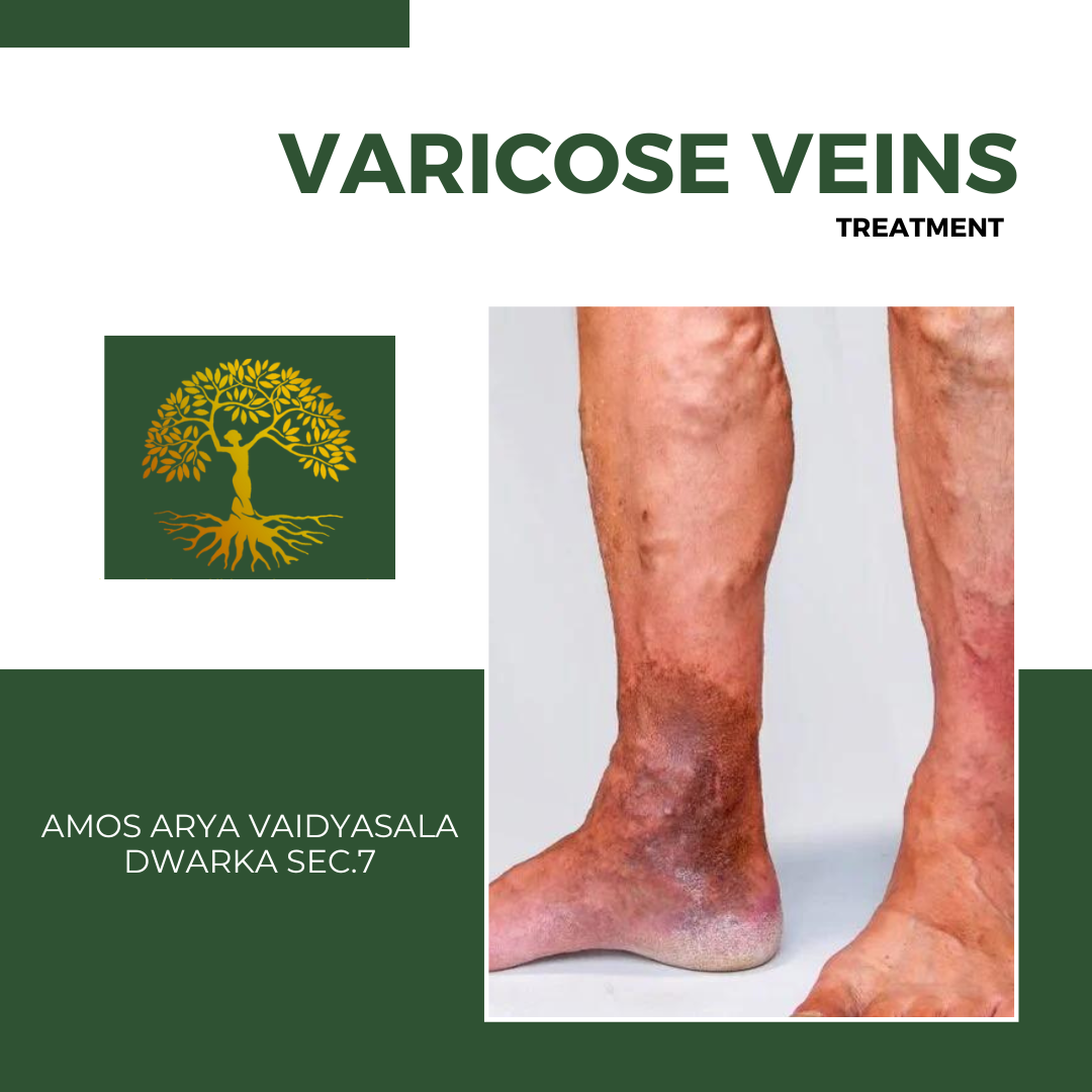 Varicose Veins Treatment